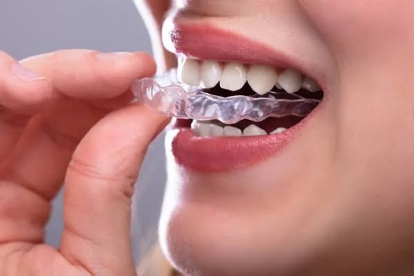 Patient placing a clear aligner tray