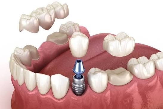 Illustration of dental crowns and bridge restorations