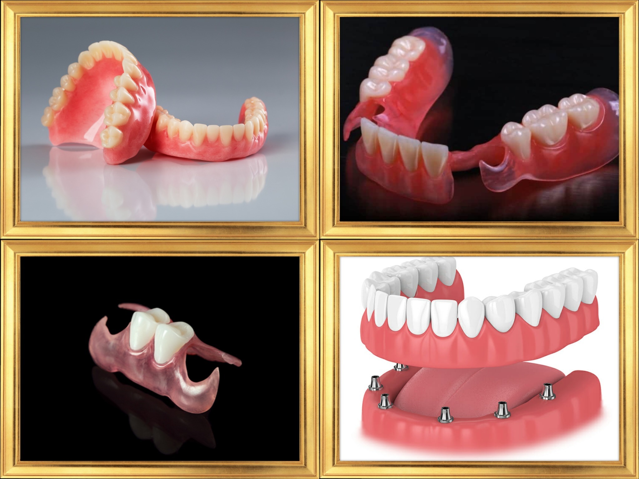 Examples of removable and implant-supported dentures