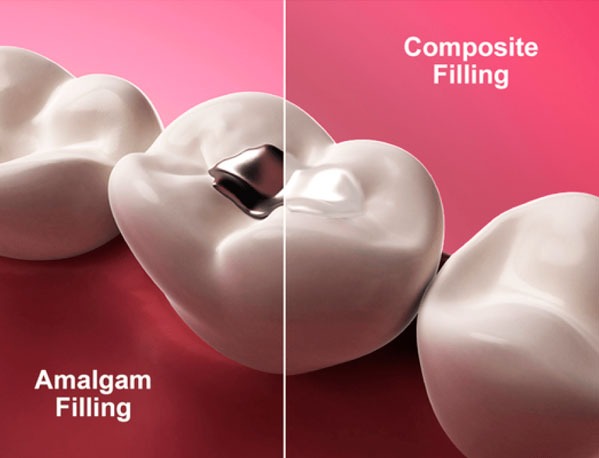 Illustration comparing amalgam and composite dental fillings