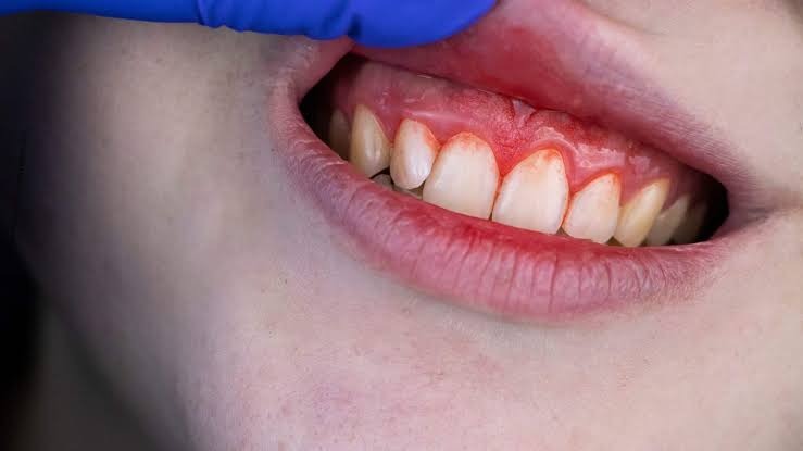 Inflamed gums showing periodontal or gum disease concerns