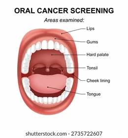 Oral cancer screening diagram showing the areas examined