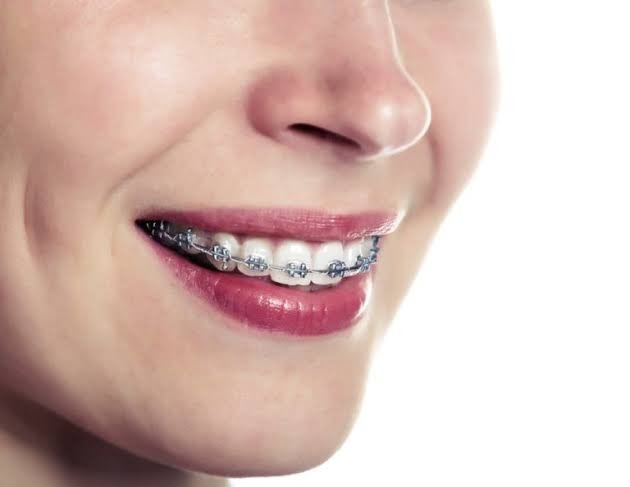 Patient smile with orthodontic braces