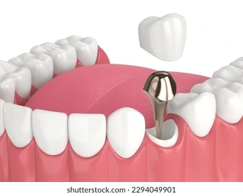 Post and core restoration with crown placement illustration