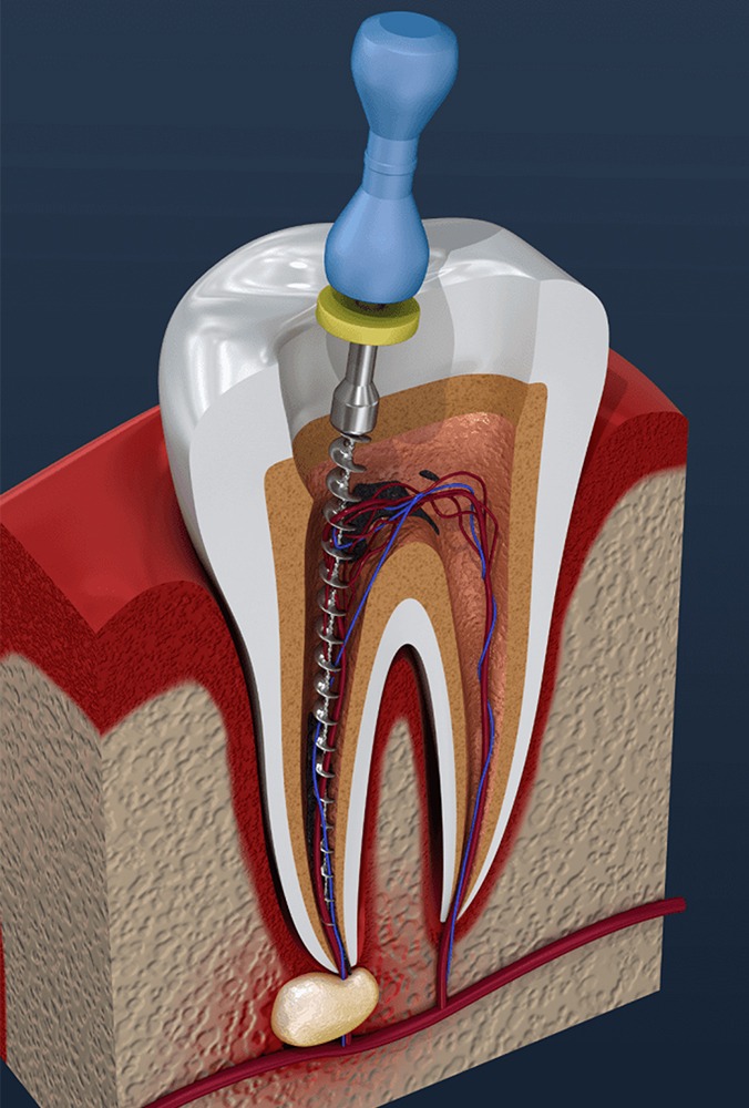Illustration of root canal treatment inside a tooth