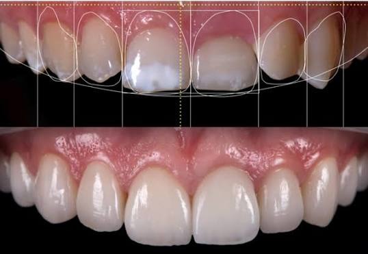 Smile designing preview and final aesthetic result