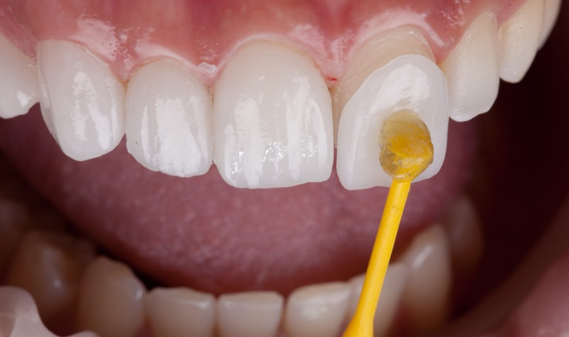 Application of a veneer or laminate on a front tooth